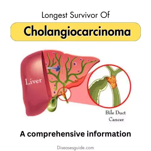 Longest Survivor Of Cholangiocarcinoma