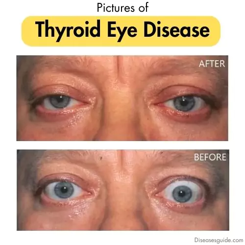 thyroid eye disease photos