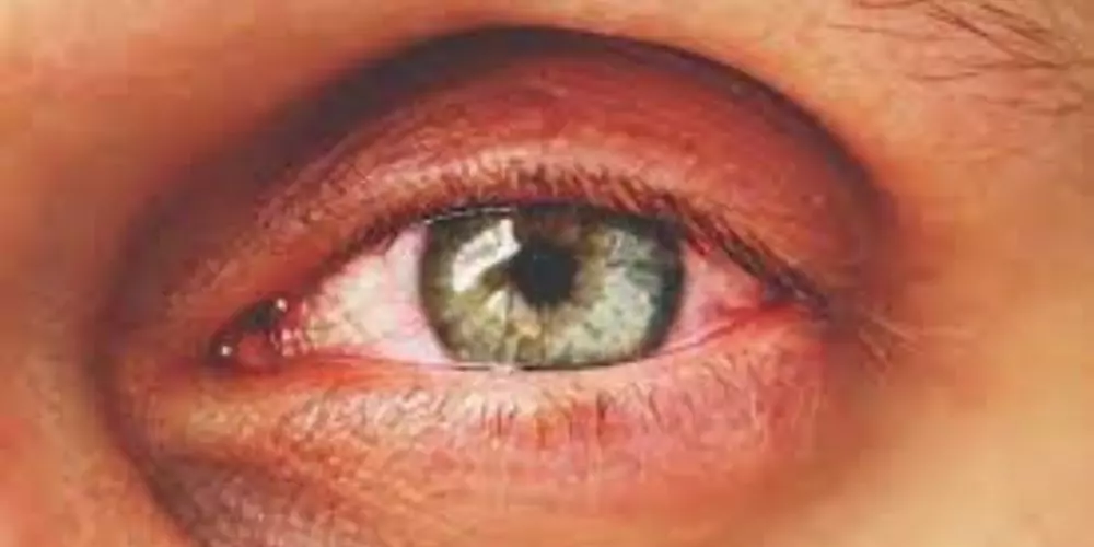 picture of someone with thyroid eye disease