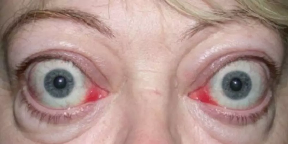 ted eye disease pictures