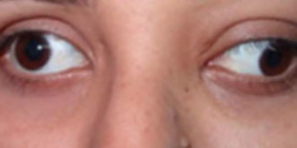 images of bulging eyes from thyroid disease