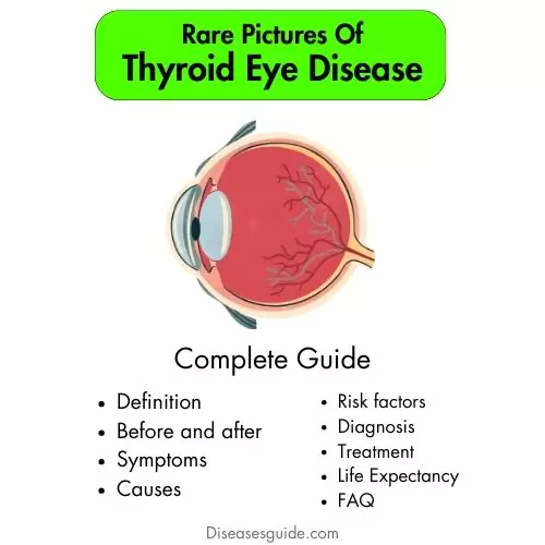 pictures of thyroid eye disease