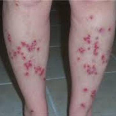 Symptoms Stages Of Morgellons Disease Pictures