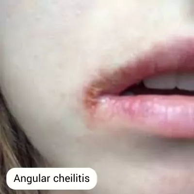 angular cheilitis