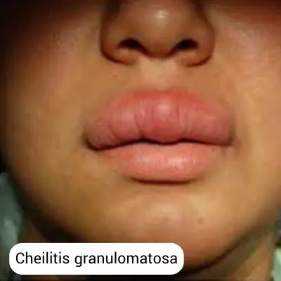 cheilitis granulomatosa