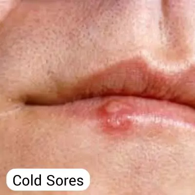 cold sores
