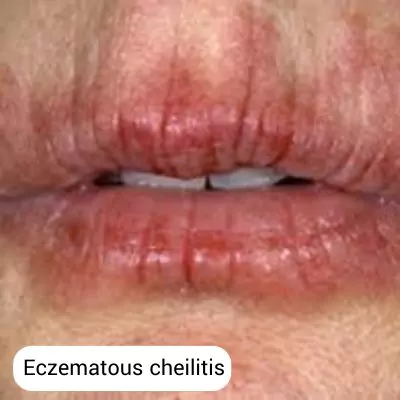 eczematous cheilitis