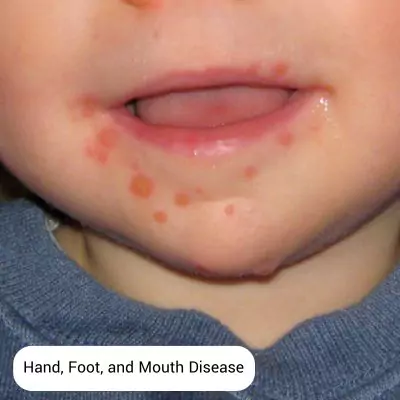 hand-foot-and-mouth-disease
