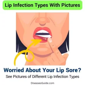 Lip Infection Types With Pictures
