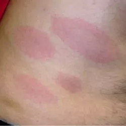 early stage lyme disease rash pictures