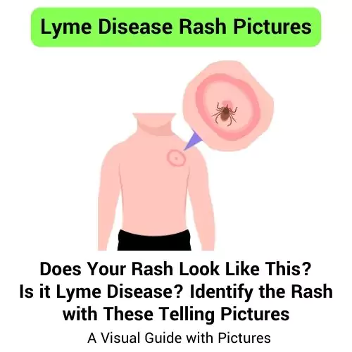 lyme disease rash pictures