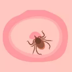 lyme disease pictures