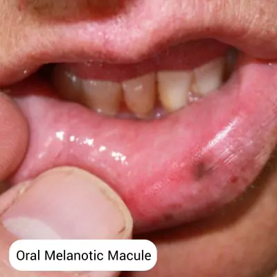 oral melanotic macule