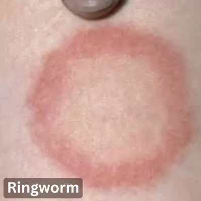 Ringworm