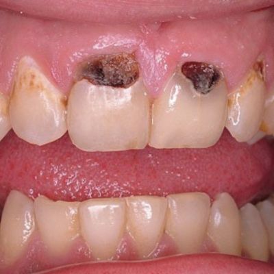 pictures of cavities between teeth