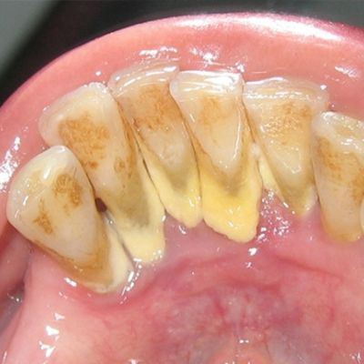 pictures of tooth decay
