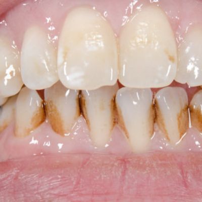 pictures of cavities on front teeth