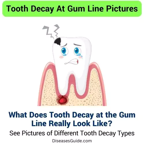 Tooth Decay At Gum Line Pictures