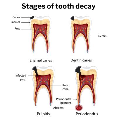 tooth decay at gum line treatment