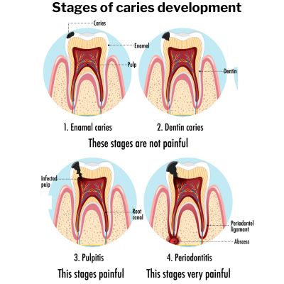 tooth decay pictures in adults