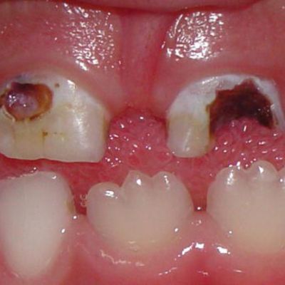tooth decay at gum line pictures
