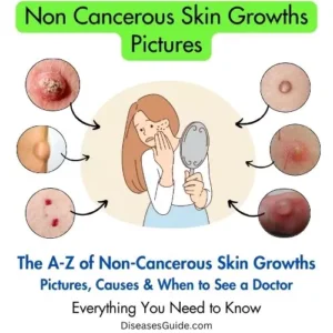 Non Cancerous Skin Growths Pictures
