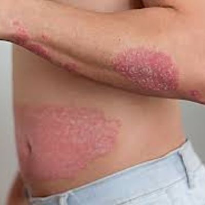 pictures of eczema and psoriasis