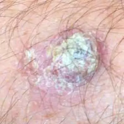 squamous cell carcinoma pictures early stages
