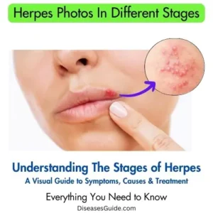 Herpes Photos In Different Stages