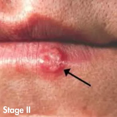 genital herpes photos in different stages