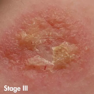 herpes photos in different stages male
