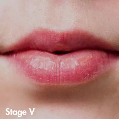 herpes photos in different stages female