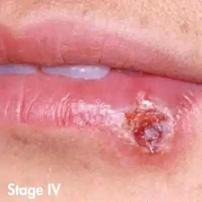 herpes photos in different stages
