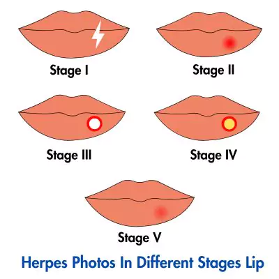Herpes photos in different stages female