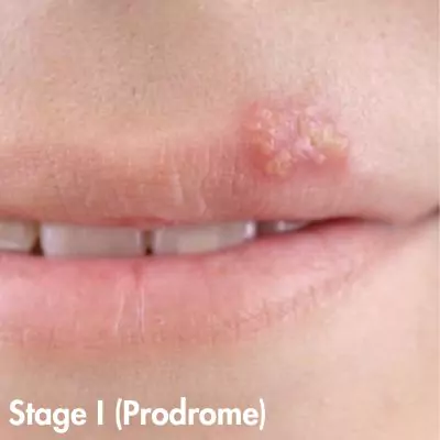 herpes photos in different stages lip