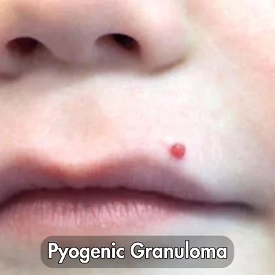 pyogenic granuloma