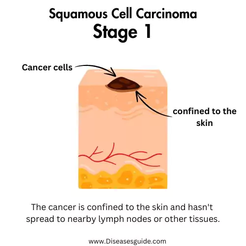 squamous cell carcinoma lung stage 1