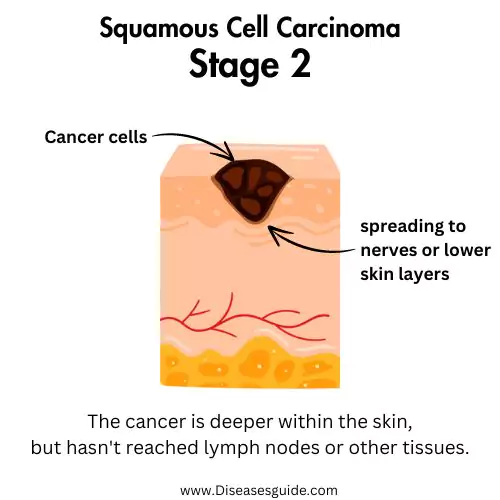 squamous cell carcinoma lung stage 2