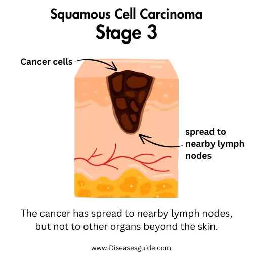 squamous cell carcinoma lung stage 3