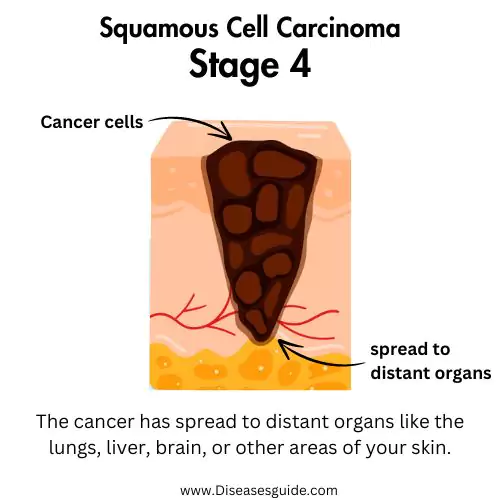 squamous cell carcinoma lung stage 4