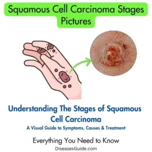 Squamous Cell Carcinoma Stages Pictures