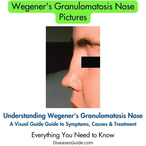 Wegener's Granulomatosis Nose Pictures