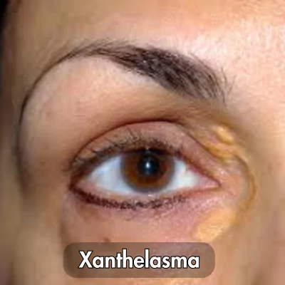 xanthelasma