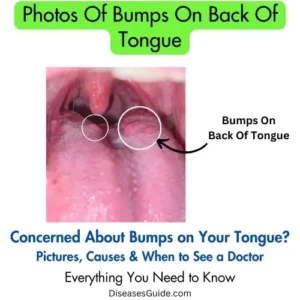 Photos Of Bumps On Back Of Tongue
