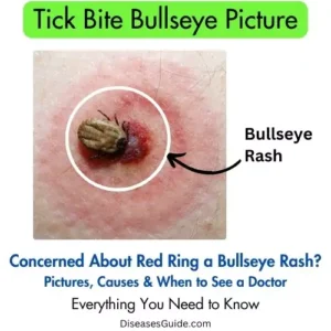 tick bite bullseye picture