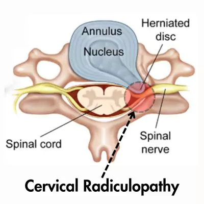 Cervical Radiculopathy