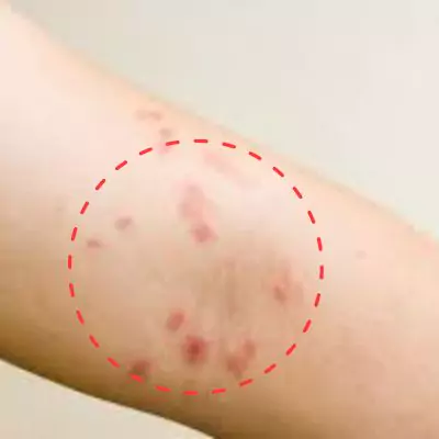 hidradenitis suppurativa scars before and after