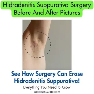 hidradenitis suppurativa surgery before and after pictures