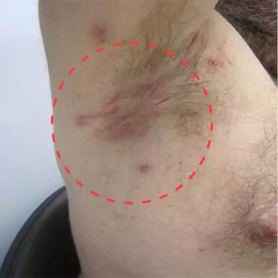 hidradenitis suppurativa stage 1 pictures