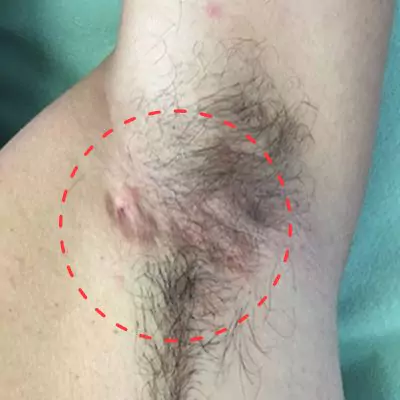 hidradenitis suppurativa surgery before and after pictures